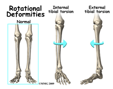 <p>Abnormal twisting of the femur that may be internal or external.</p><p>Abnormal twisting of the tibia that may be internal or external.</p><ul><li><p>causes in and out toeing </p></li></ul><p></p>