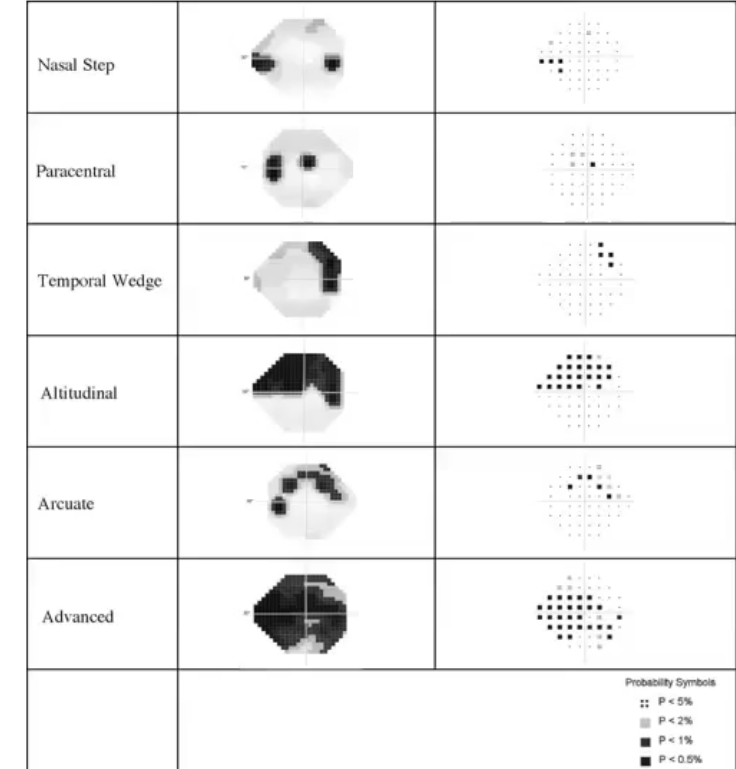 <p>glaucoma field defects: patterns of loss </p>