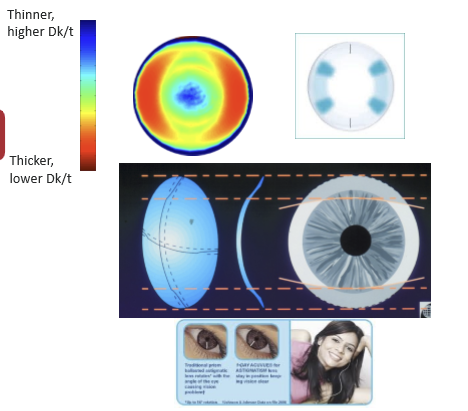 <p>Dual thin-zone lenses are blink stabilized. They use thinner superior and inferior zones that interact with both eyelids through the watermelon seed principle, helping the lens settle into a stable orientation.</p>