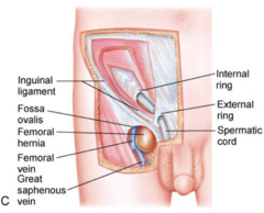 <p>Inspect and palpate anterior thigh region over femoral canal while patient stands and performs Valsalva maneuver.</p>