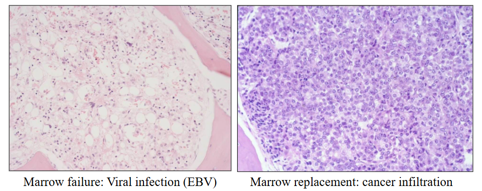 <p>Bone Marrow Failure</p>