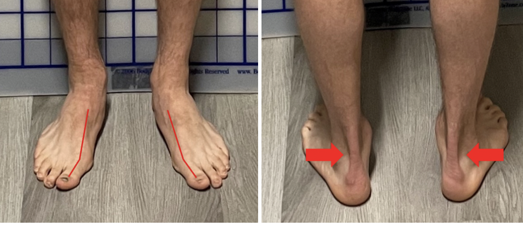 <p>Collapsed arches &amp; Big toe valgus: consequences</p>