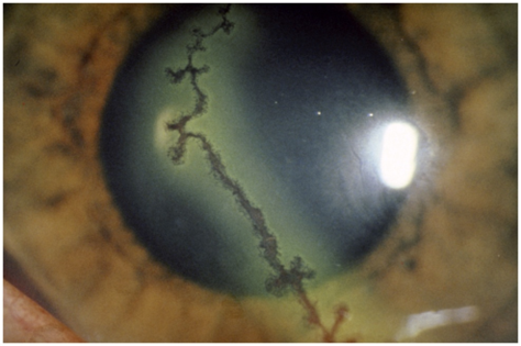 <p>Causative Agent: Human Herpesvirus, directly transmitted via touching the eye after contact with cold sores or fomites.<br>Symptoms/Signs: Ocular lesions, which may worsen with reactivation to produce corneal scarring or blindness.</p>
