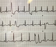 <p><span>unifocal:</span> extra beats look identical on ECG tracing, originate from a single, specific location</p><p><span>bifocal</span>: extra beats in <strong>two distinctly different shapes or forms</strong> on the ECG, two different locations inside the ventricles</p><p><span>cuplet</span>: pattern or grouping rather than shape of beat, <strong>two PVCs happen back-to-back</strong>, with no normal heartbeats between them</p>