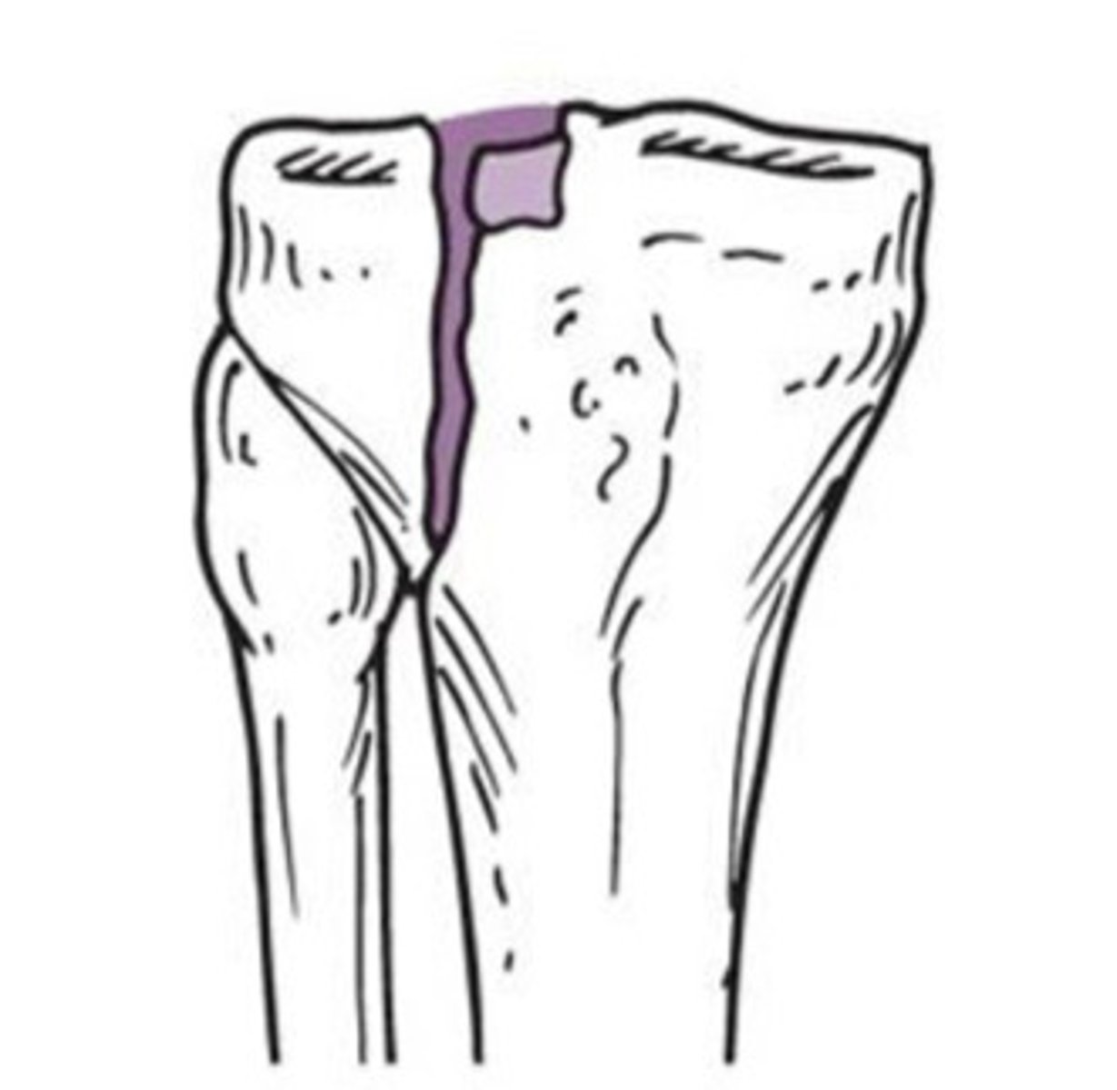 <p>What type of fracture does this show?</p>