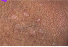 <p>- apocrine sweat glands abundant in skin of labia major and mons, active after puberty</p><p>- due to occlusion of ducts with keratin and cause vulvar pruritus</p>