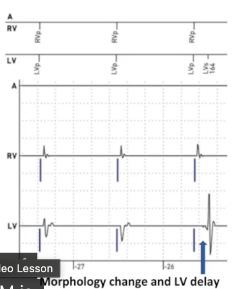 <ul><li><p>Loss of LV capture difficult to see on surface ECG</p></li><li><p>Nearfield helps to differentiate intrinsic/paced</p></li><li><p><strong>Lost capture: delay between pacing and LV signal</strong></p><ul><li><p>No capture at all: LBBB</p></li><li><p>Only RV capture: cell to cell activation from RV lead</p></li></ul></li></ul><p></p>