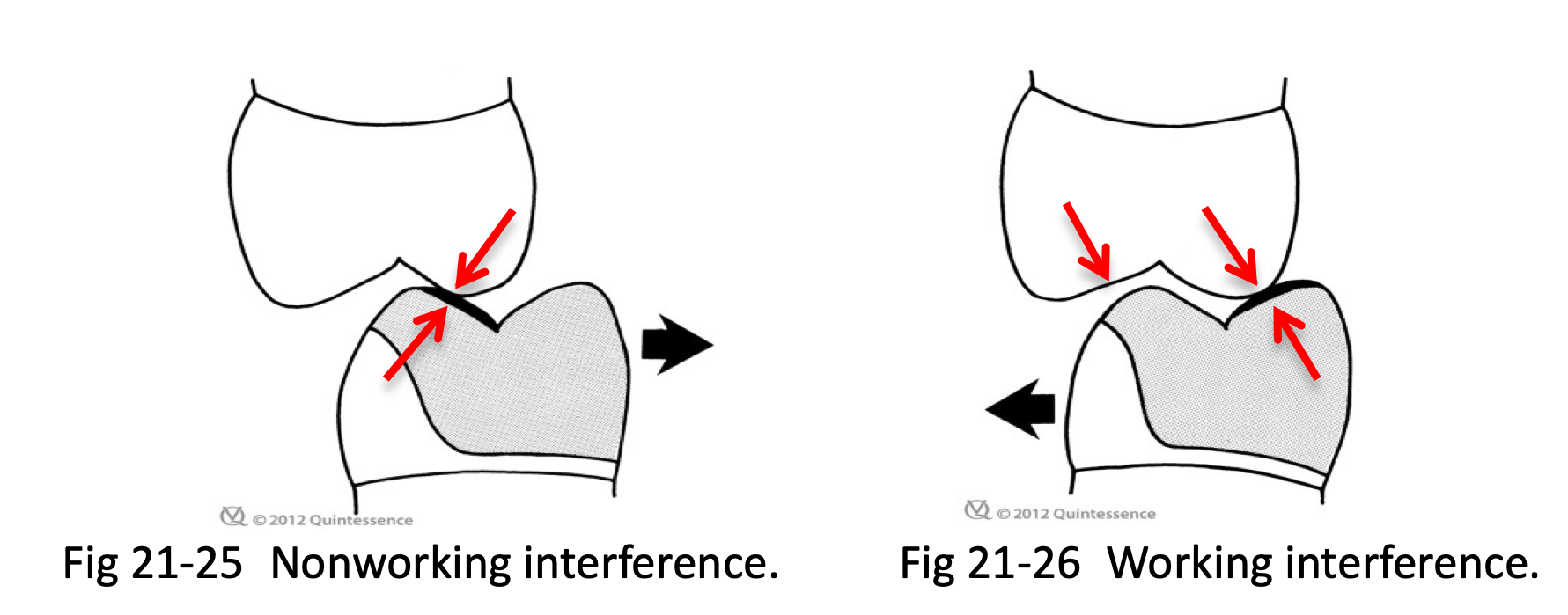 <ul><li><p>BULL (buccal upper, lingual lower) on balancing side (nonworking side)</p></li><li><p>LUBL (lingual upper, buccal lower) on working side</p></li></ul><p></p>