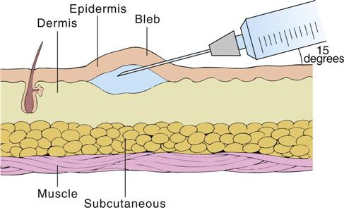 <p>15 degrees</p><p>TB skin tests</p>