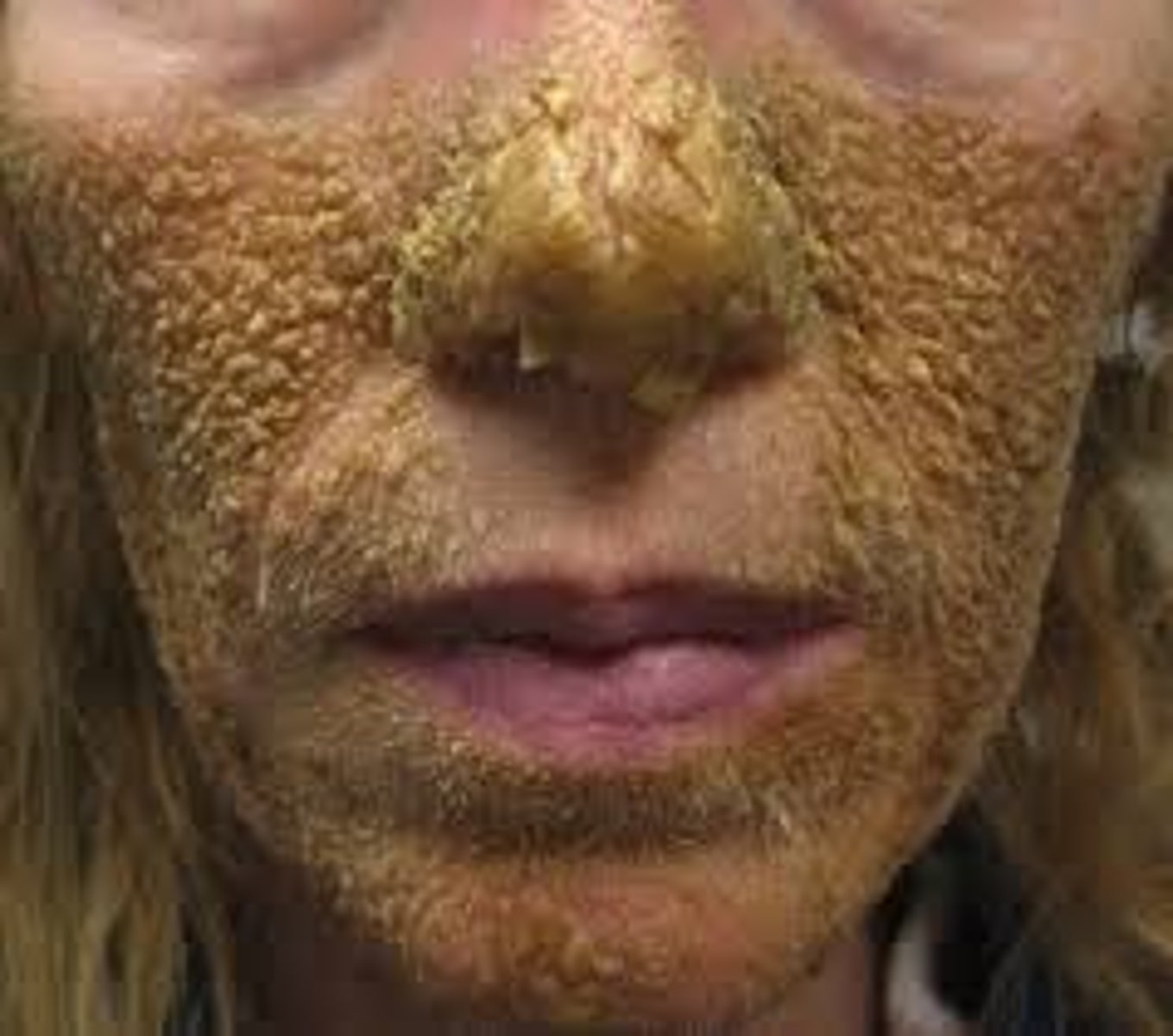 <p>The hereditary tendency for acne-prone skin to retain dead cells in the follicle, forming an obstruction that clogs follicles and exacerbates inflammatory acne lesions such as papules and pustules.</p>
