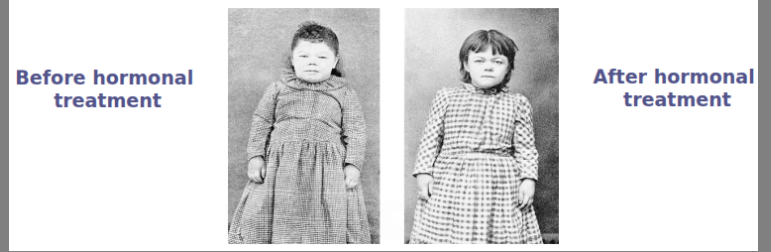<ul><li><p>low quantities of thyroxine produced during childhood (hypothyroidism) results in a condition called <strong>cretinism</strong></p></li></ul><p></p><ul><li><p>due to improper development of the thyroid gland</p></li><li><p>physical symptoms include:</p><ul><li><p> stocky and shorter than average stature</p></li><li><p>enlarged facial features</p></li><li><p>mental development delays\</p></li></ul></li></ul><p></p><ul><li><p>sufferers must receive regular hormonal injections early on in life</p></li></ul><p></p>