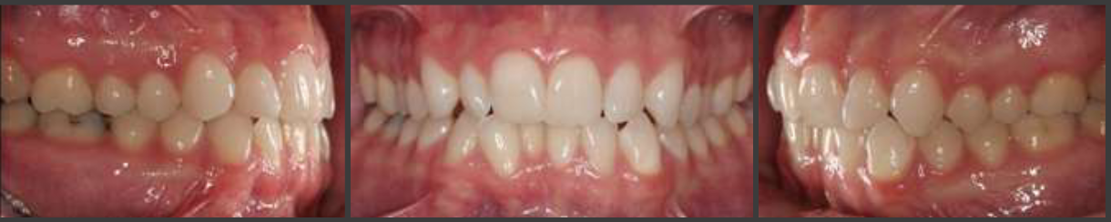 <p>how would you class this occlusion </p>