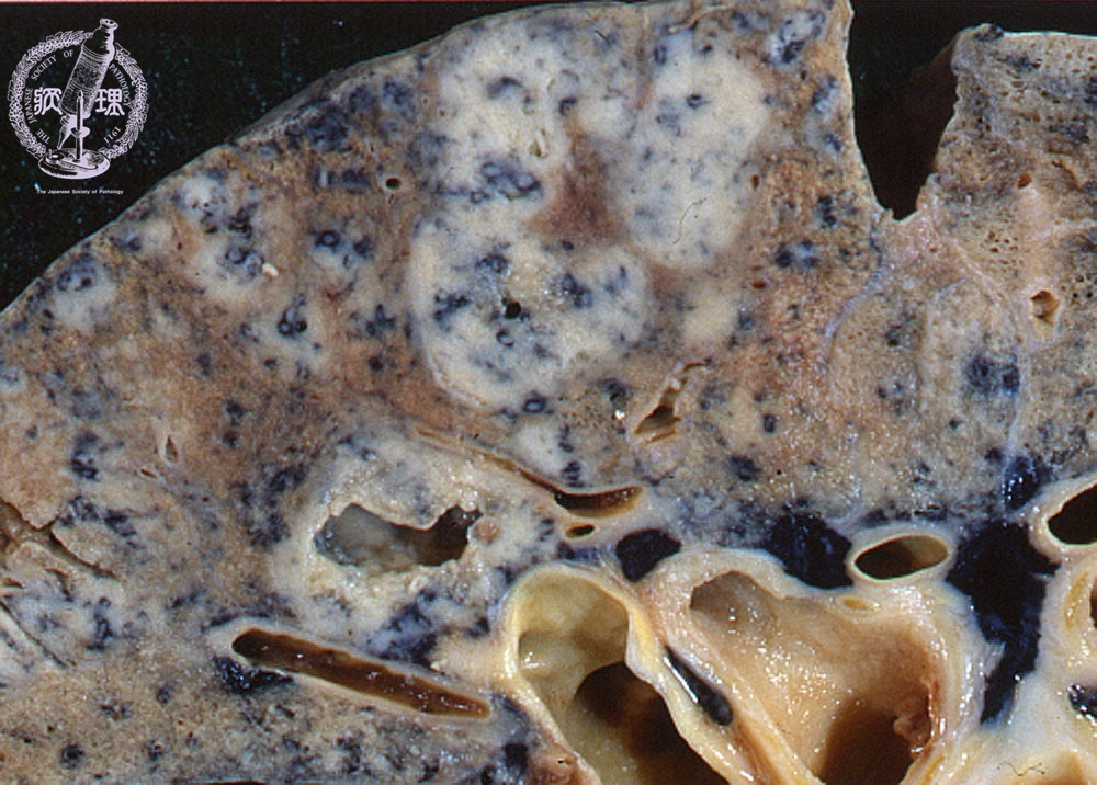 <p>tuberkuliozė</p>