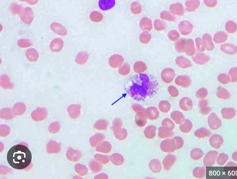 <ul><li><p>Visible vacuoles (clear holes/empty spaces) in the cytoplasm neutrophils </p></li></ul><p></p>