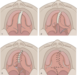 <p>What is this cleft palate repair technique?</p>