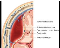 <p>Subdural hematoma </p>