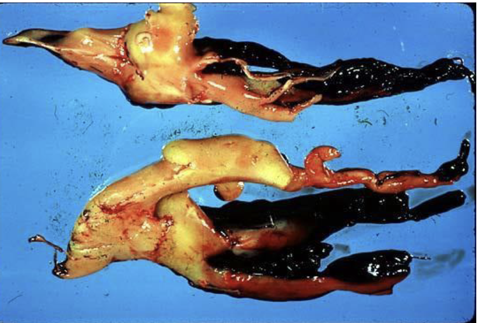 <p>describe and name this clot</p>