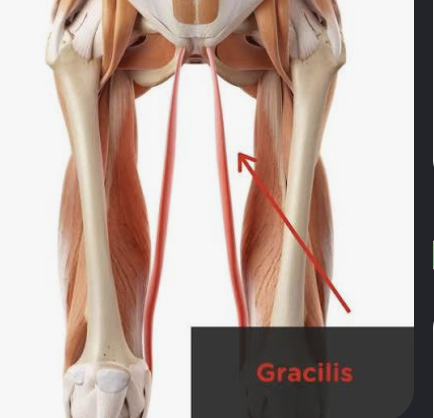<p>Actions- hip adduction, knee flexion, medial rotation of leg</p><p>Functional Groups-</p><ul><li><p>Synergists- adductor longus, adductor magnus, sartorius</p></li><li><p>Antagonists- gluteus medius, gluteus minimus, tensor fasciae latae</p></li></ul><p></p>