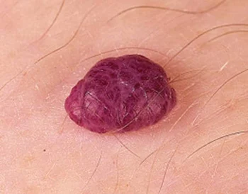 <p>angioma (e.g. cherry angioma) (vascular lesions)</p>