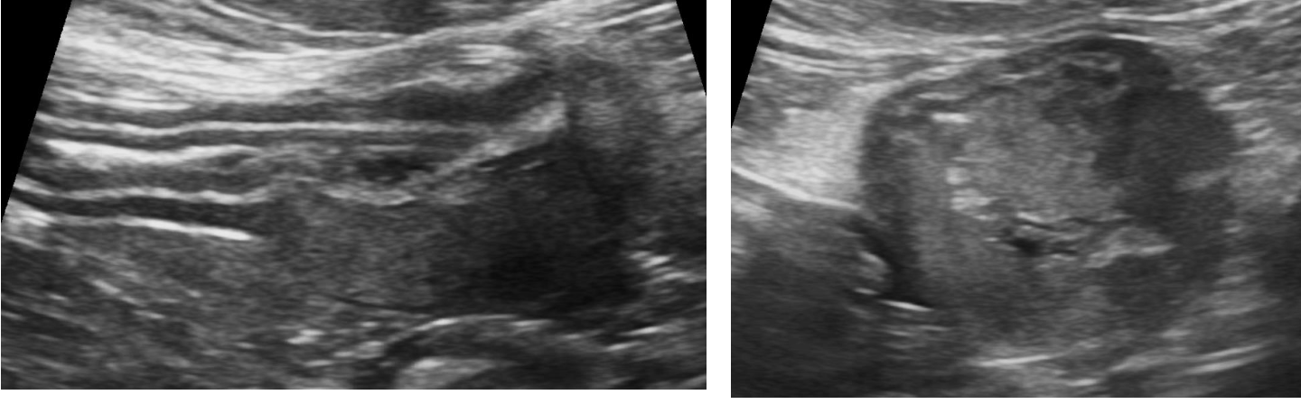 <p>what does the following ultrasound show?</p>