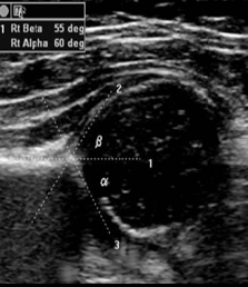 <p>Which angle is used to evaluate hip dysplasia?</p>