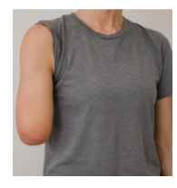 <p>this image shows a major UE unilateral right elbow articulation amputation</p><p>t or f</p>