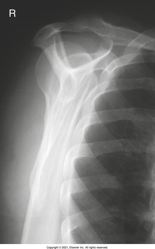 <p>body of scapula should be end on without superimposition over ribs, acromion and coracoid process Y ( humeral head in the sub acromial space) </p>