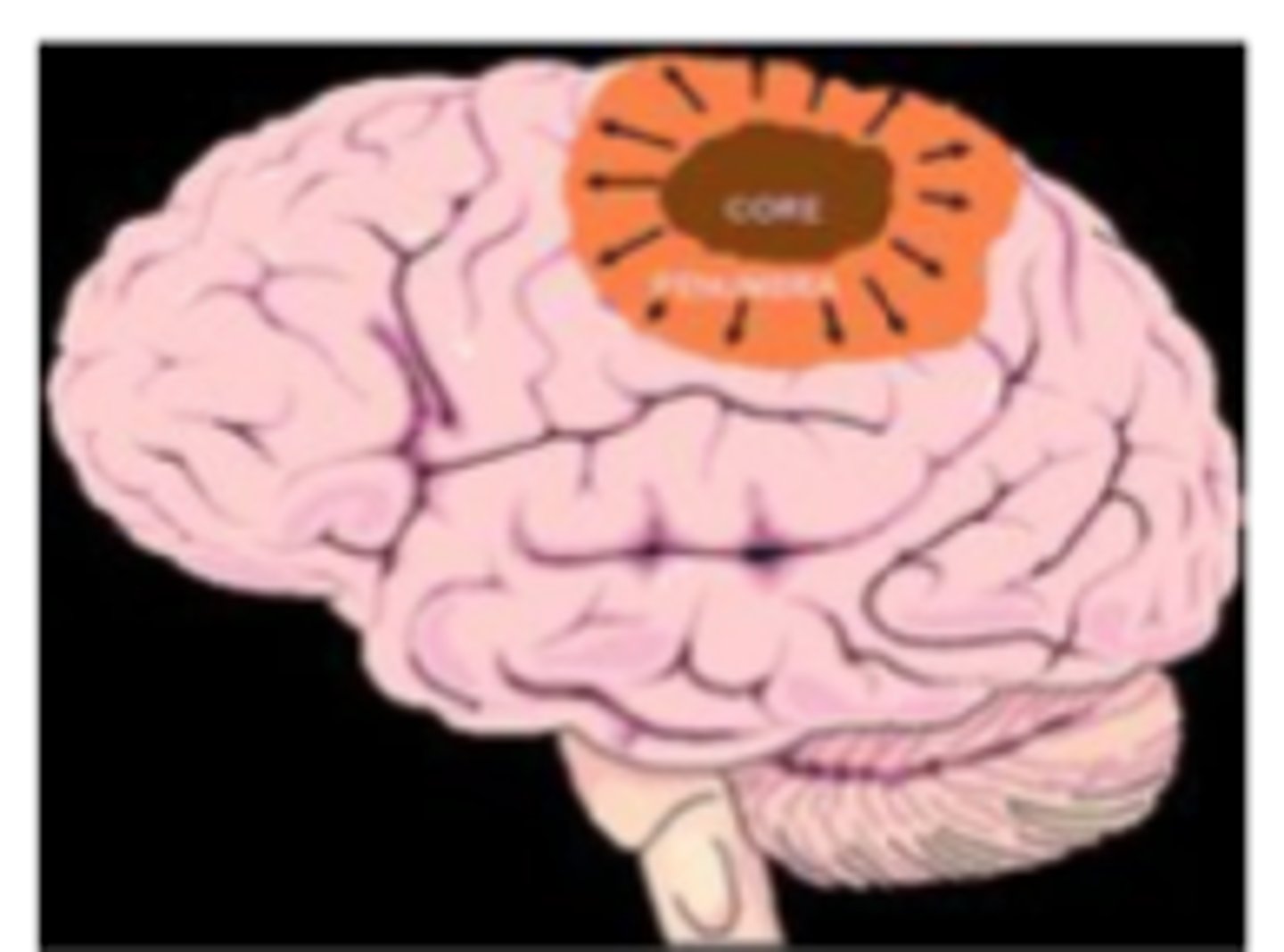 <p>infarcted brain tissue supplied immediately upstream of clot/aneurysm</p><p>tissue is DEAD & can't be recovered</p>