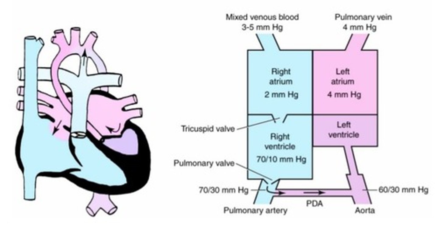 <p>a. Atrial septal defect</p><p>b. Hypoplastic left ventricular syndrome</p><p>c. Hypoplastic right ventricular syndrome</p><p>d. Atrioventricular canal defect</p>
