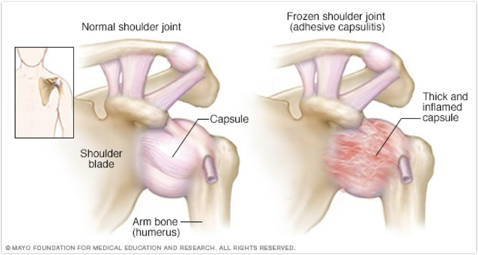 <p>Frozen Shoulder/Adhesive Capsulitis treatment </p>