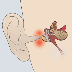 <p>Any condition or disease that<u><mark data-color="green" style="background-color: green; color: inherit;"> impedes the conveyance of sound in its mechanical form</mark></u><strong> through the middle ear cavity to the inner ear.</strong></p>
