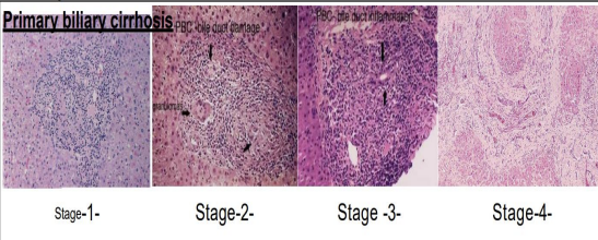<p>Stage 1: Bile duct inflammation &amp; damage (early portal tracts with lymphocytes and plasma cells destroying ducts). </p><p>Stage 2: Granulomatous inflammation surrounding damaged ducts (hallmark). </p><p>Stage 3: Cholestatic changes (bile ductular proliferation, periportal Mallory's hyaline, increased copper in periportal hepatocytes). </p><p>Stage 4: End stage micronodular cirrhosis with subsided inflammation.</p>