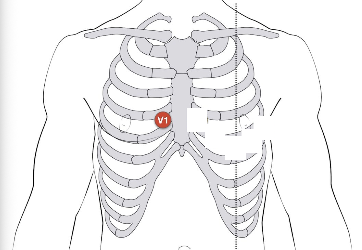 <p>V1 placement - 12-lead EKG</p>