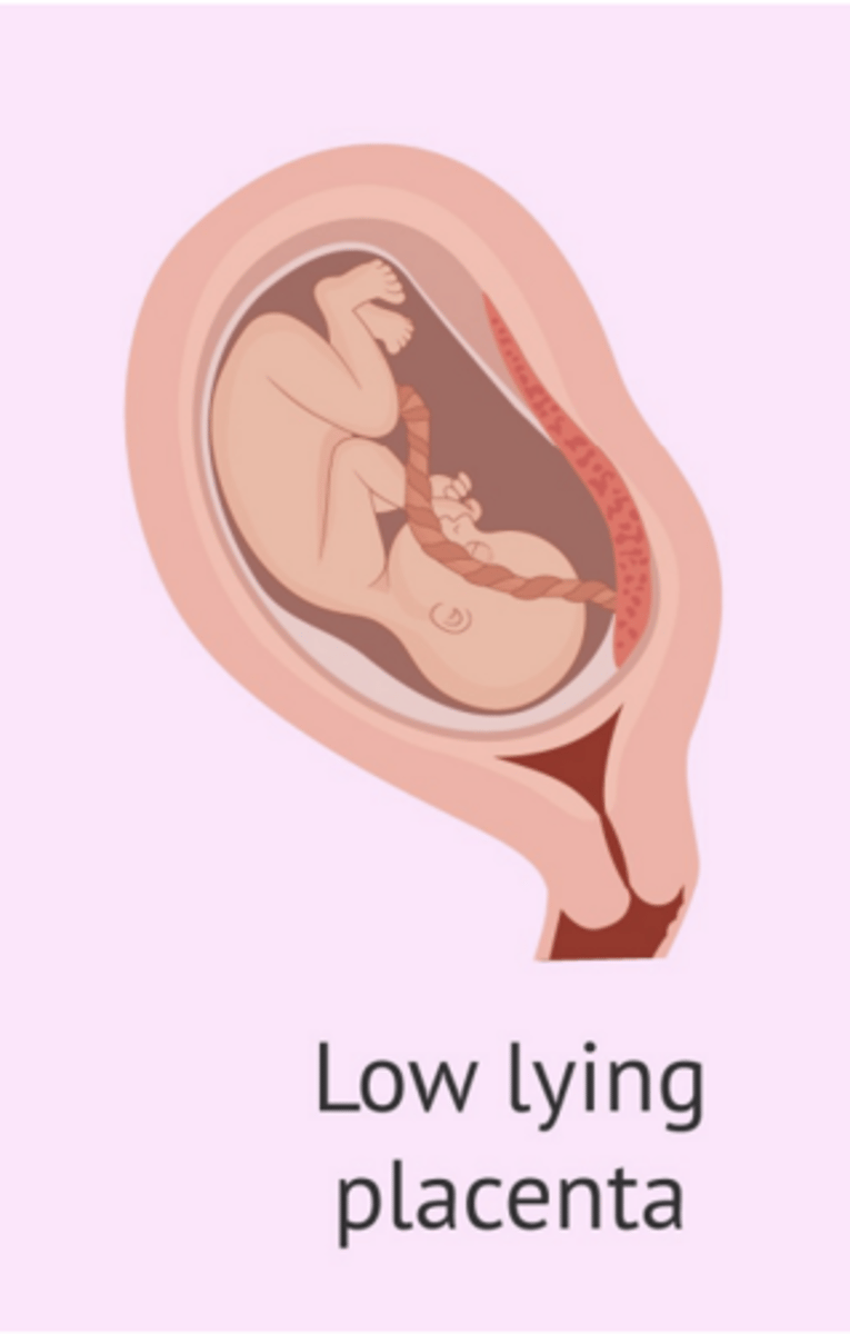 <p>Placenta edge extends into lower uterine segment but is more than 2cm from the cervical os</p>