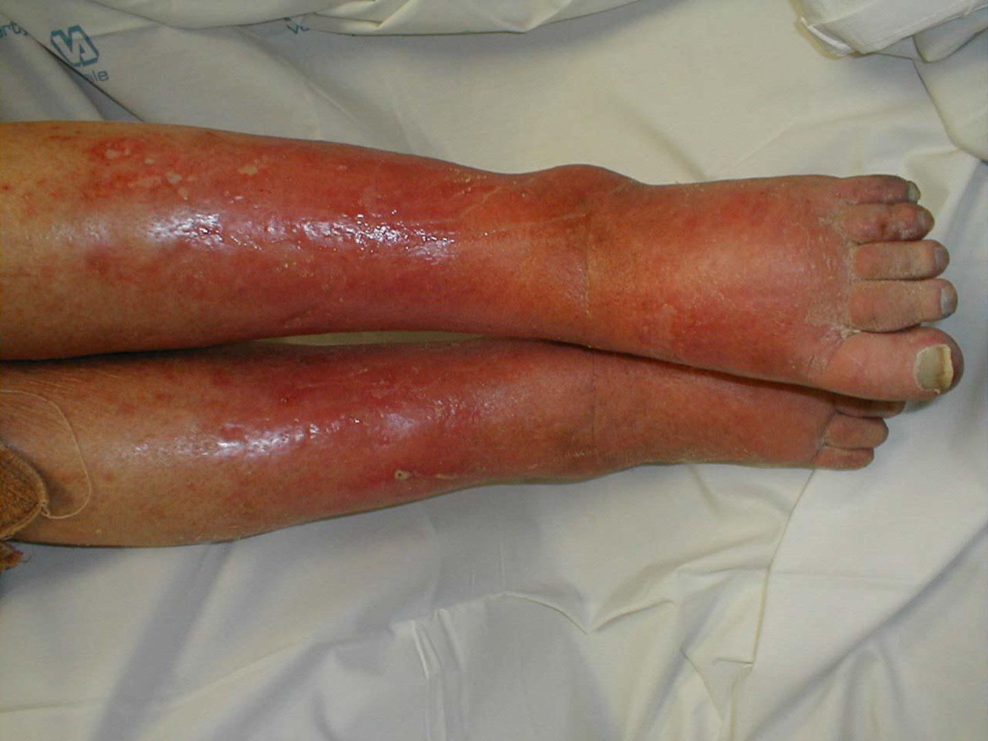 <p>bacterial infection of the skin</p>