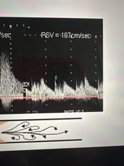 <p>velocity will begin to decrease again and pressure will rise higher than in the stenosis</p>