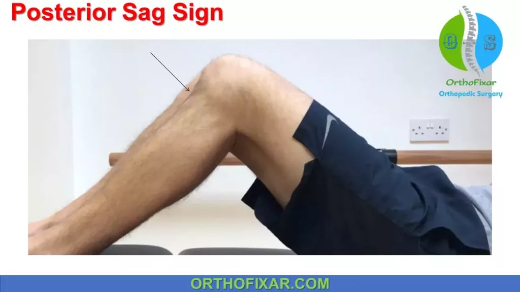 <p>Posterior Sag sign (Godfrey’s Test) </p>