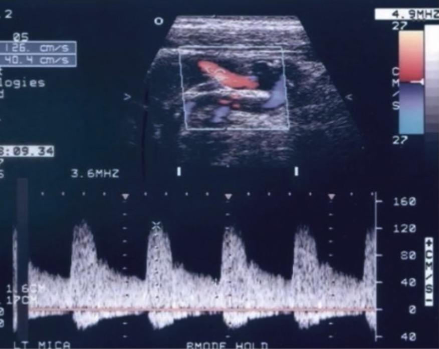 <p><span><span>How would you describe the type of spectral Doppler flow observed in this image?</span></span></p>
