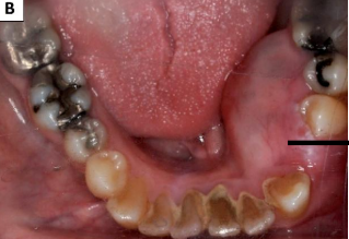<p>Clinical presentation of cysts and tumors of jaw</p>