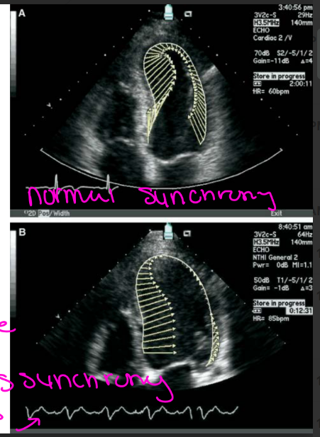 <p>The heart muscle does not contract in a uniform matter in DCM</p><p>(the septal and lateral wall are not firing at the same rate)</p>