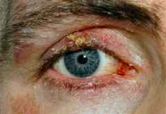 <p>Inflammation of the eyelids</p><p>Erythema, crusty with scaling debris that clings to lashes.</p><p>Eyelid hygiene, warm compresses, baby shampoo</p>