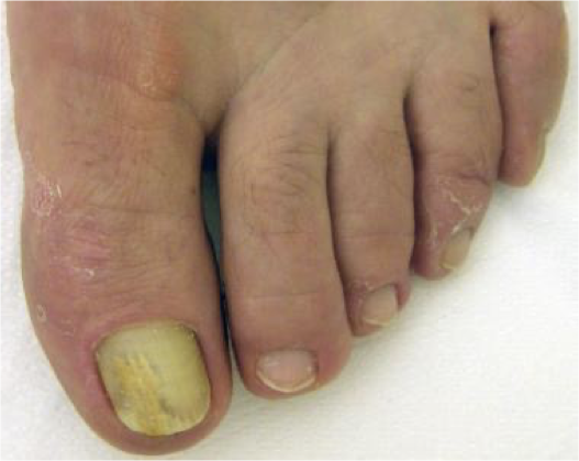 <p>What does this refer to</p><ul><li><p>Fungal infection of the toenails or fingernails</p></li><li><p>May involve any component of the nail unit</p><ul><li><p>Matrix, bed, or plate</p></li></ul></li></ul><p></p>
