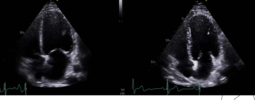 <p>ALCOHOLIC CARDIOMYOPATHY</p>