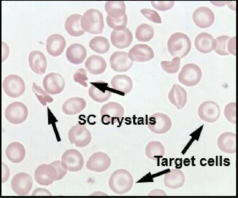 <p><strong>Smear Findings</strong></p><ul><li><p>target cells</p></li><li><p>many bizarre SC crystals</p></li><li><p>if any sickles are present, it’s NOT Hgb SC</p></li></ul><p><strong>MCV</strong>: 82-98</p><p></p>
