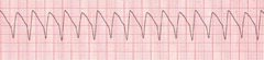 <p>atrial rhythm and rate cannot be identified </p><p>"Tombstones"</p>