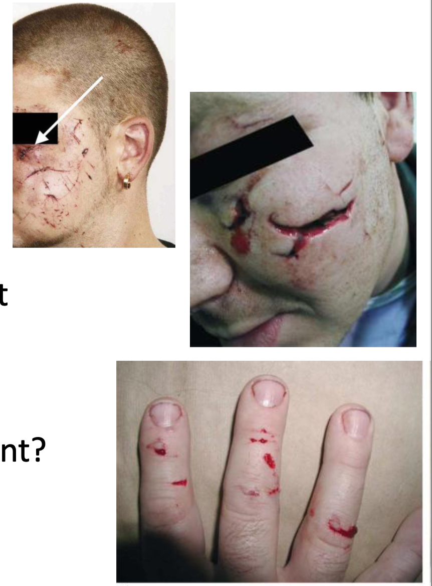 <p><strong>Glass injuries:</strong> wounds caused by <strong>broken or intact glass</strong>, producing <strong>incised wounds or lacerations</strong>.</p><p></p><p class="isSelectedEnd"><strong>Common scenarios:</strong></p><ul><li><p><strong>Burglary (broken window)</strong> → burglar often receives <strong>multiple cuts</strong> when climbing through shattered glass.</p></li><li><p><strong>Broken glass used in assault</strong> → <strong>multiple deep incised wounds</strong>.</p></li><li><p><strong>Intact glass breaking on impact</strong> (e.g., fall into window) → usually <strong>more superficial cuts</strong>.</p></li><li><p><strong>Impact with intact glass object</strong> → may cause <strong>lacerations</strong> rather than clean cuts.</p></li></ul><p></p><p class="isSelectedEnd"><strong>Forensic significance:</strong></p><ul><li><p>Important to determine <strong>when the glass broke</strong> (before, during, or after the injury).</p></li><li><p>Helps interpret <strong>intent</strong> (e.g., accident, burglary, or assault).</p></li></ul><p></p>