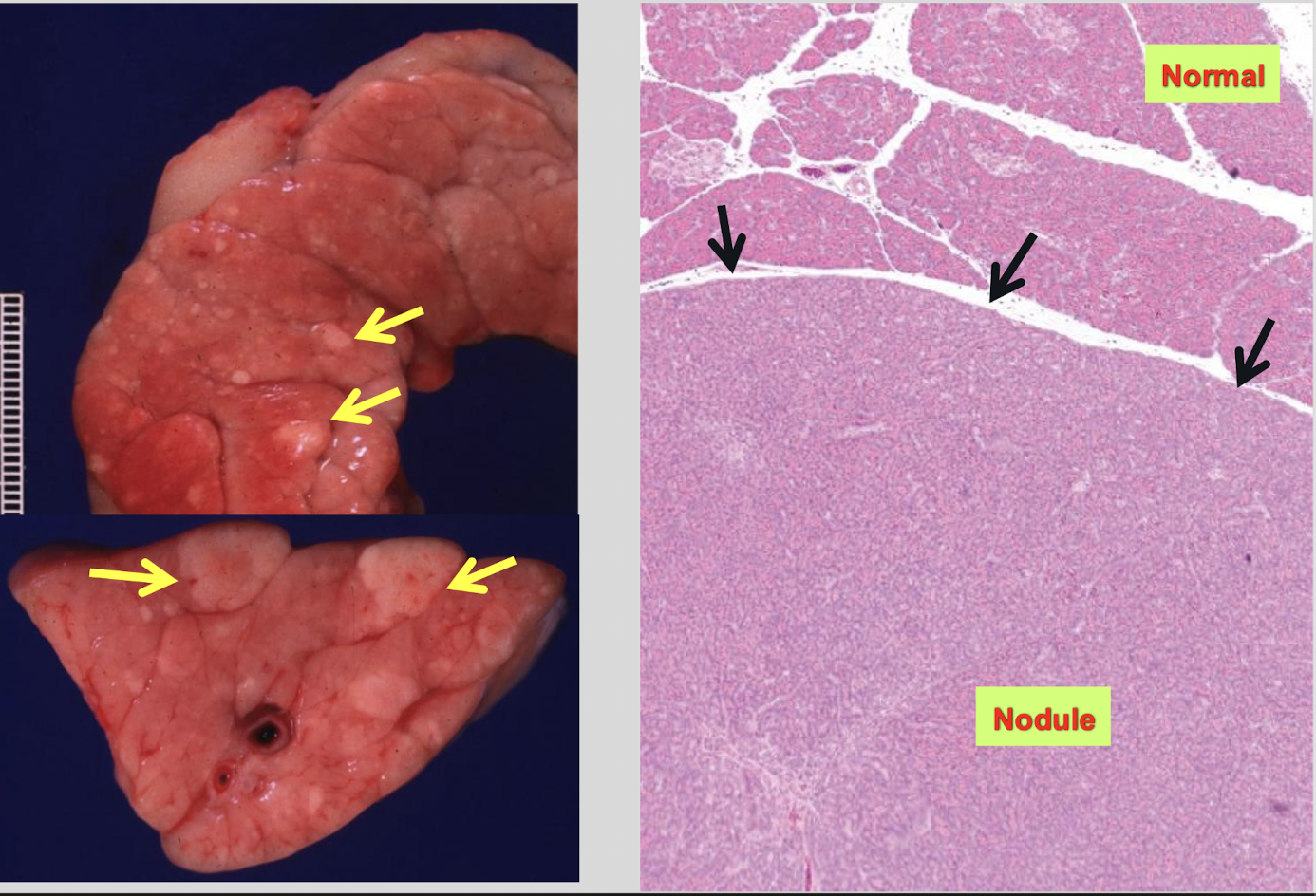 <p><strong><u>hyperplasia</u></strong> = multifocal, small, well-circumscribed, non-invasive</p><p><strong><u>neoplasia</u></strong> = adenoma or adenocarcinoma, typically solitary &amp; larger, invasive growth &amp; cytologic atypia</p>