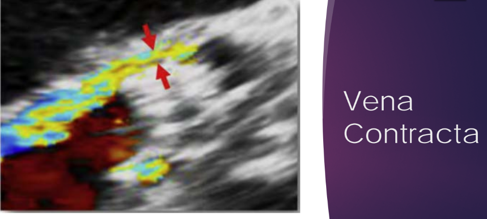 <p>Flow convergence, VC, and proximal jet extension into the LVOT and left ventricle</p>