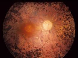 <p>Retinitis Pigmentosa s/sx</p>