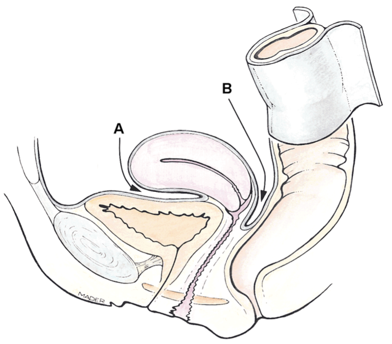 <p>vesicouterine pouch </p>